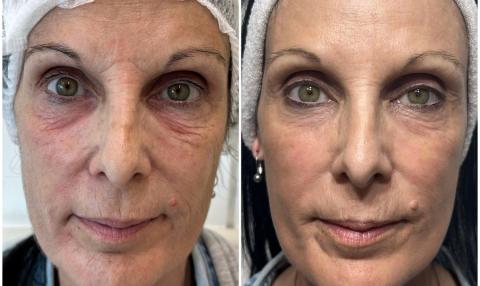 Tratamientos con láser Co2 fraccionado o rejuvenecimiento facial