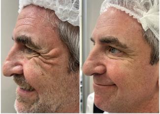 Aplicación de toxina botulínica