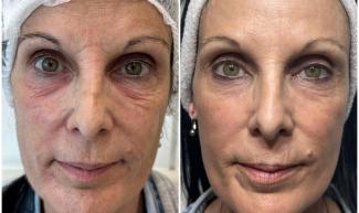 Tratamientos con láser Co2 fraccionado o rejuvenecimiento facial