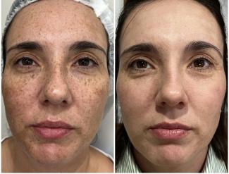 Tratamiento Luz Pulsada