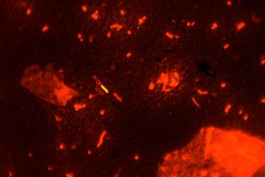 Tuberculosis