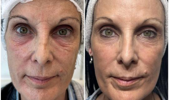 Tratamientos con láser Co2 fraccionado o rejuvenecimiento facial