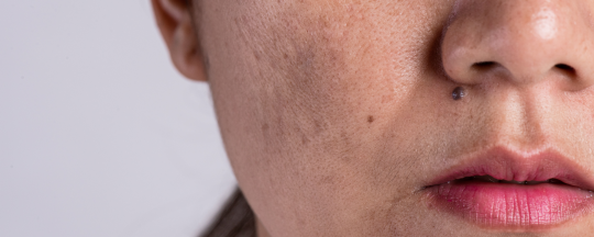 Estetica y Laser