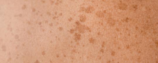 Dermatología