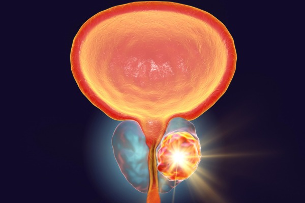 IA PROSTATA
